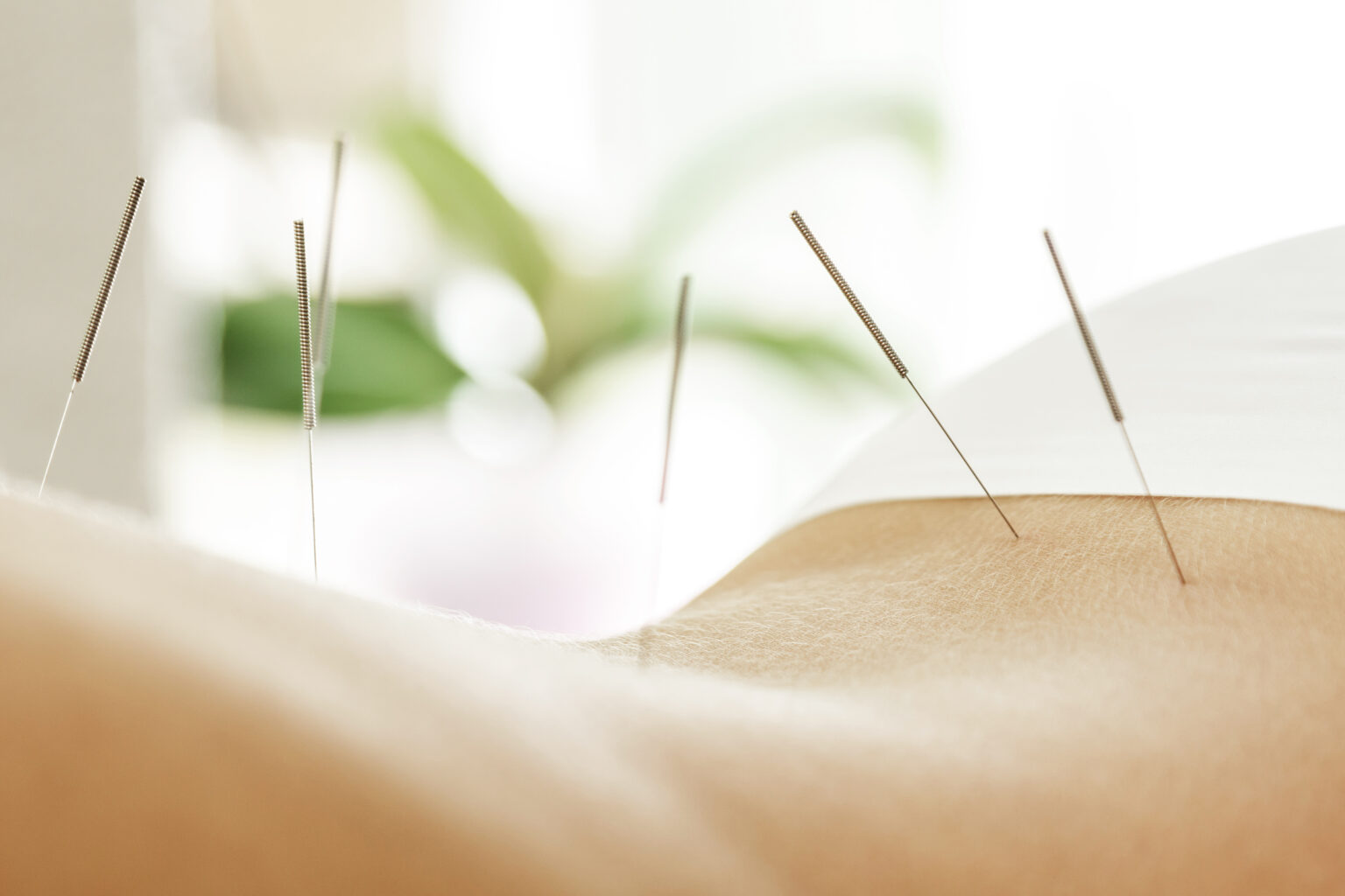 Alternative medicine. Close-up of female back with steel needles during procedure of acupuncture therapy.